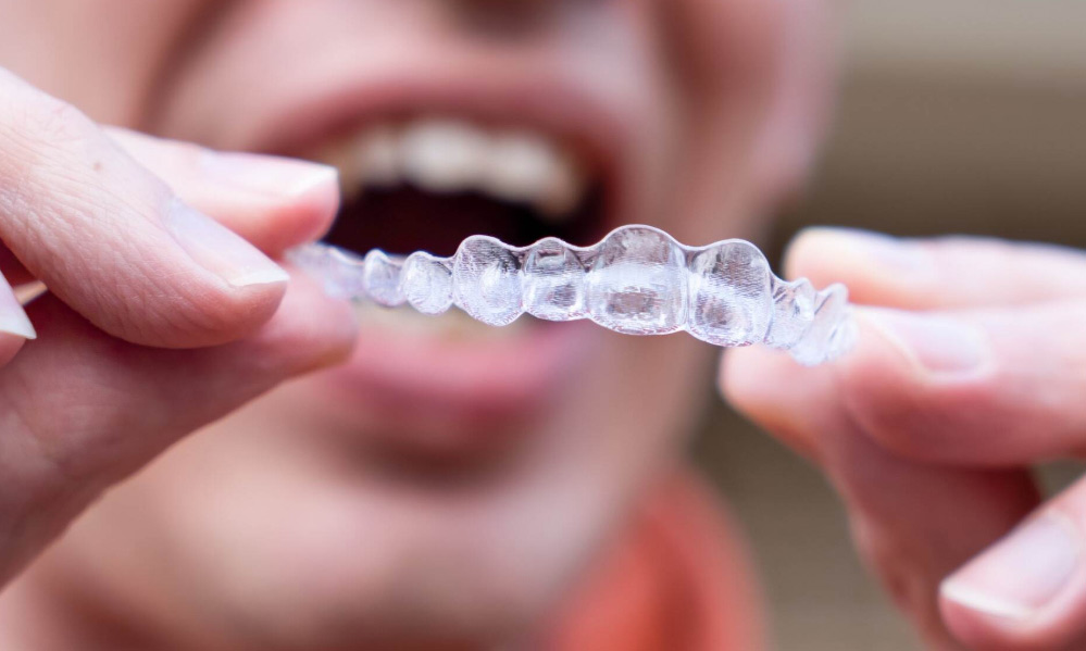 aligners1